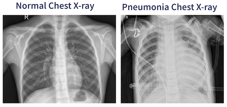 normal chest x-ray sitiated next to a chest x-ray exhibiting pneumonia